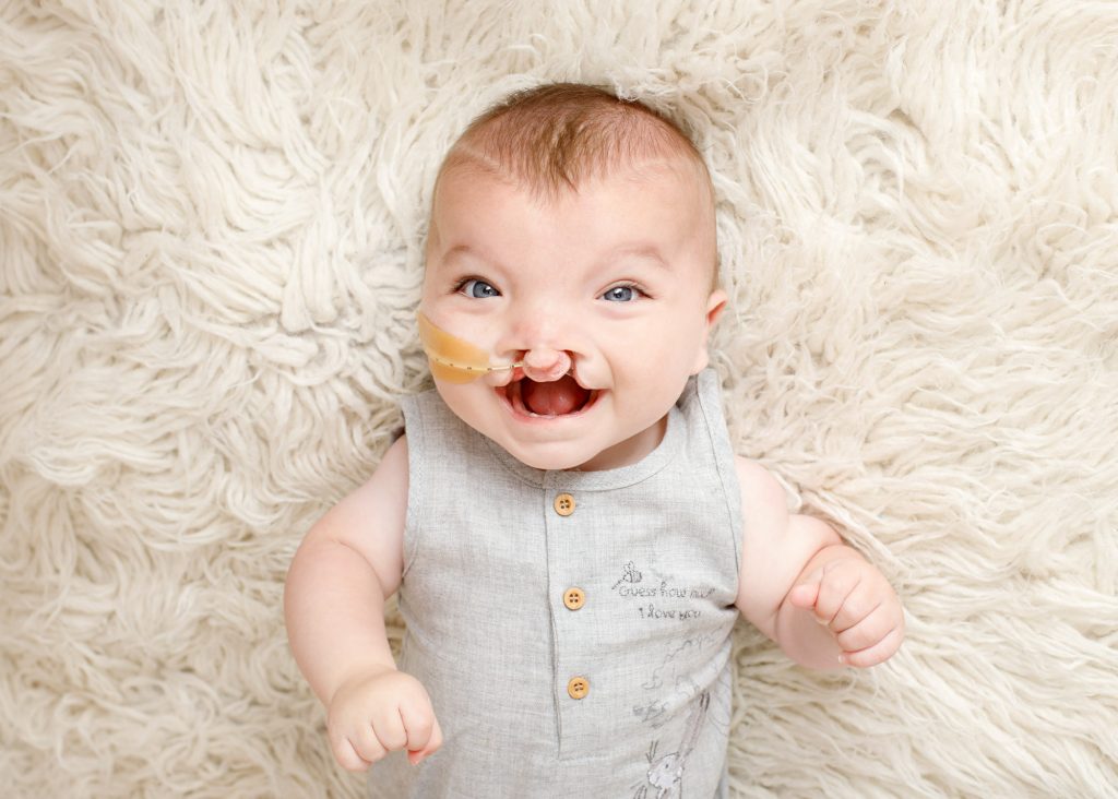 baby boy with a cleft pallet smiling with feeding tube photographed in kent